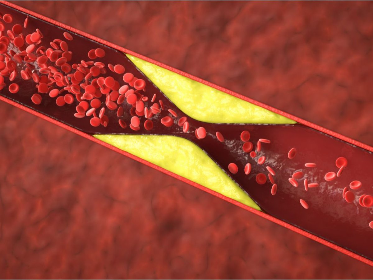 Venous duplex ultrasound for DVT diagnosis at South Texas Vascular Institute in Edinburg, TX