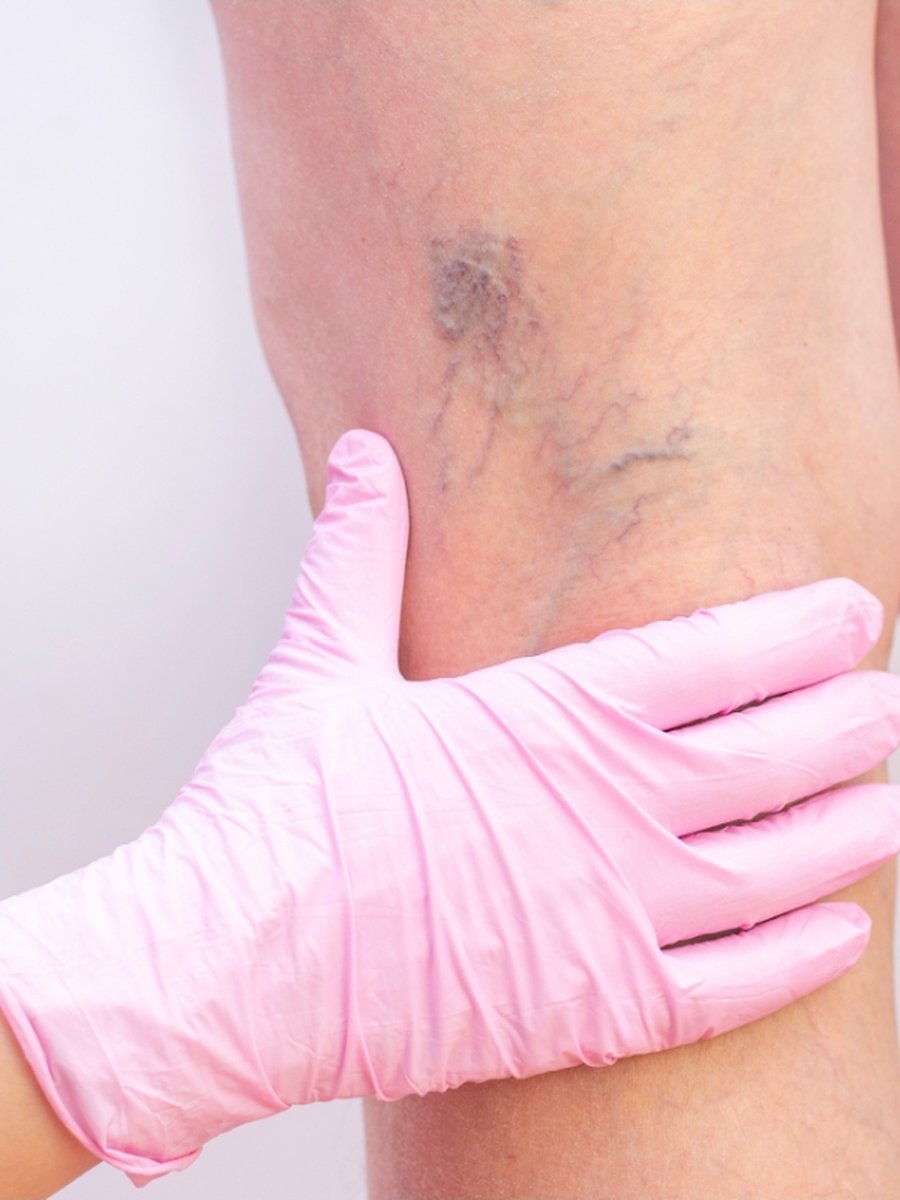 Dr. Ralph H. Brookshire III, DO, performing radiofrequency ablation at South Texas Vascular Institute in Edinburg, TX