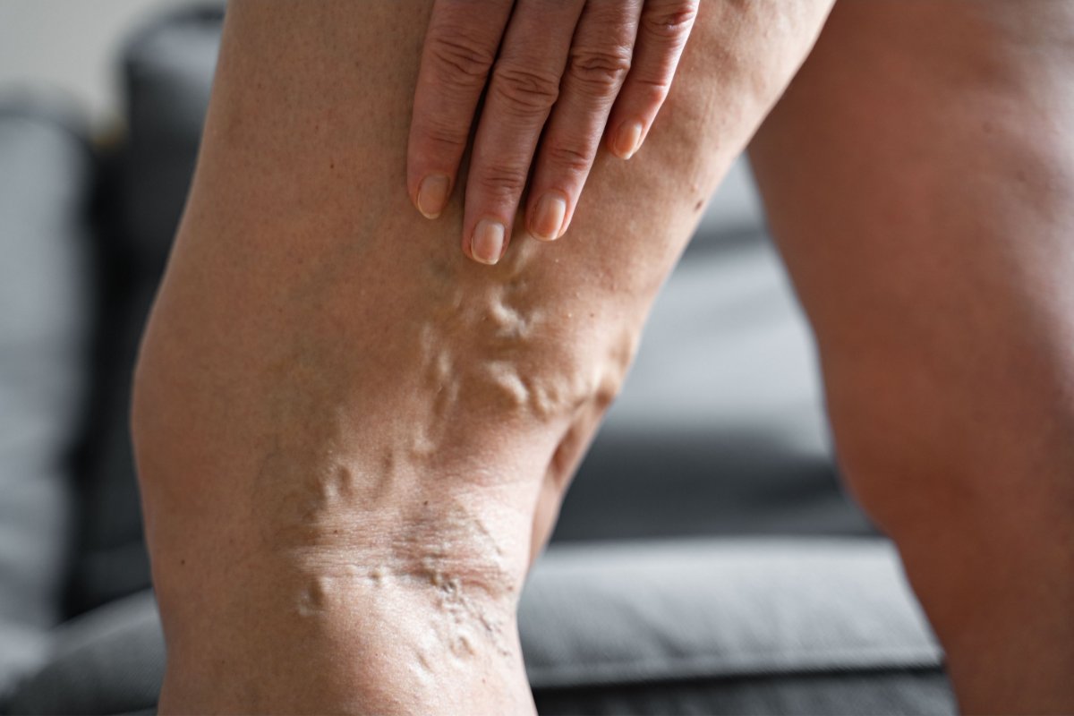 Venous duplex ultrasound mapping for varicose veins at South Texas Vascular Institute in Edinburg, TX